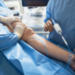 Médicos realizando procedimento cirúrgico em paciente com varizes, utilizando técnica tradicional para tratar veias dilatadas nas pernas