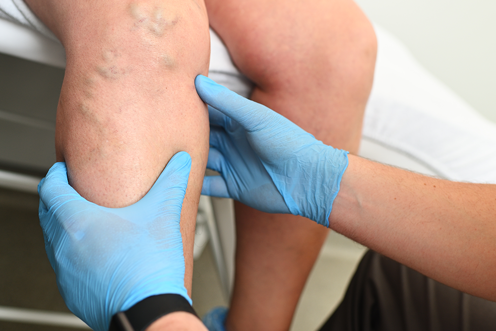 Médico examinando pernas de paciente com varizes, avaliando veias dilatadas antes do tratamento vascular